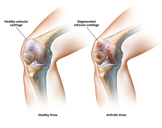 osteoarthritis-healthy-vs-arthritic-articular-cartilage